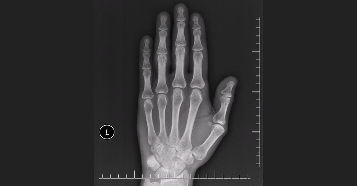 Can You Spot Fracture in These X-Ray Images?